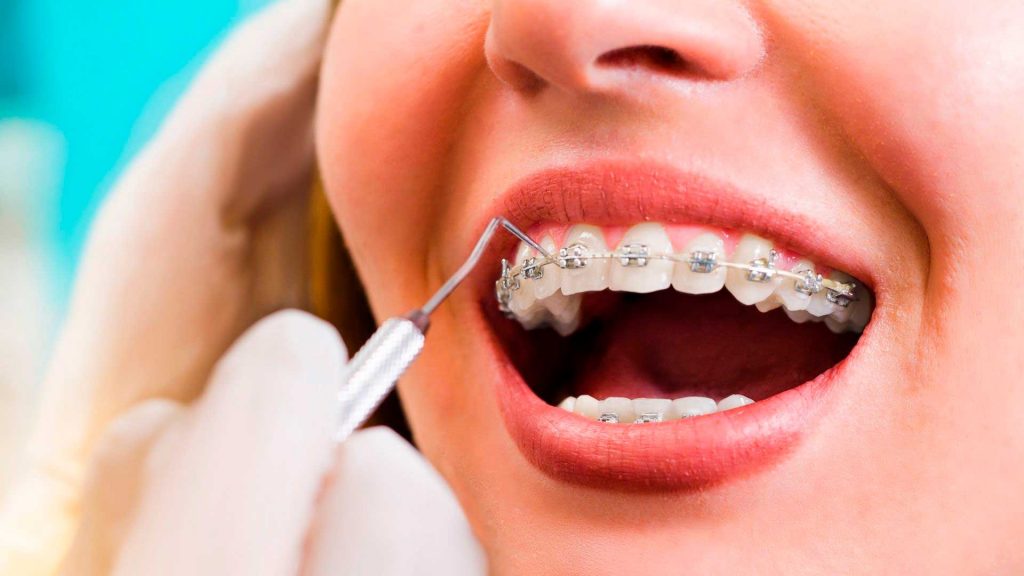 brackets